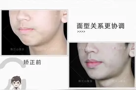 15岁男生下巴后缩，3号牙长不出来，怎么办？不拔牙矫正能解决！图片