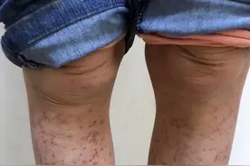 过敏性紫癜图片