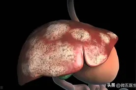肝癌治不好？活10年以上完全有可能！双博士讲发现肝癌后最佳方案图片