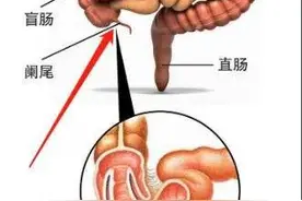 阑尾炎微创手术陪护经历，术前，术后需要注意什么图片