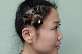 45岁爱美女士从沈阳来北京做拉皮，3个月过去了，像变了一个人图片