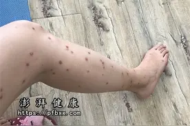 腿上胳膊上身上长硬硬的凸起疙瘩特别痒，是什么病吃什么药能止痒图片