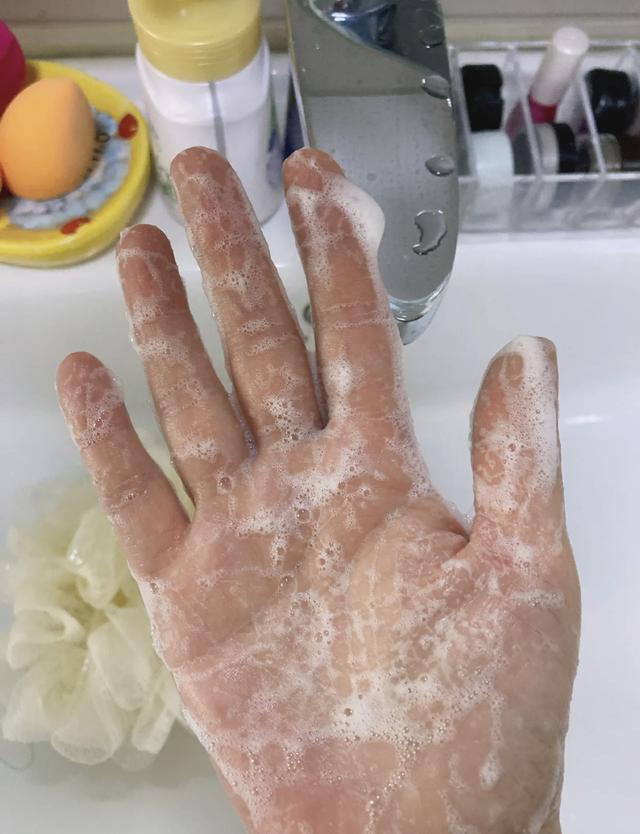 涂了身体乳还是有白屑