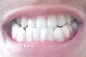 科普宣教：含在嘴里的“地包天”图片