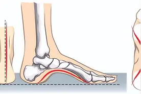 冉冉科普｜躲过了扁平足，却没躲过高足弓图片
