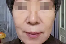 51岁拉皮术后60天，从松弛大妈到清爽姐姐，看着年轻了20岁？图片