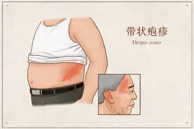 专攻这类人群！痛起来要人命的“不死癌症”——带状疱疹图片