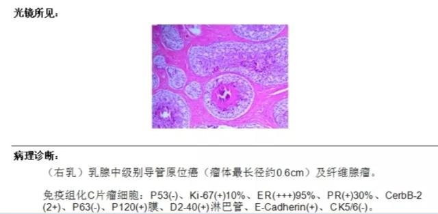 联合检查,让乳腺导管原位癌无处可逃