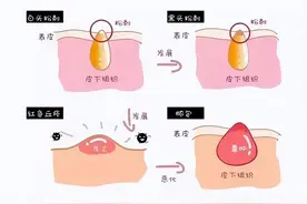 爆痘、粉刺、黑头齐聚一堂，我的脸还有救吗？图片