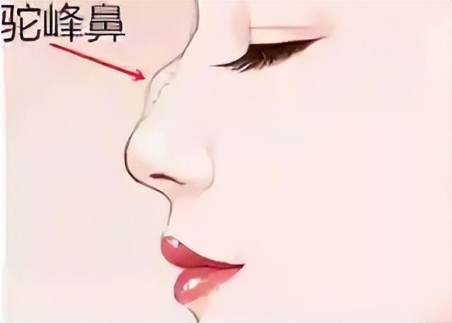 打了玻尿酸,高鼻梁拯救五官立体感!