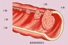 每天坚持锻炼，排便规律，为何突然查出肠癌？运动防癌是假的吗？图片