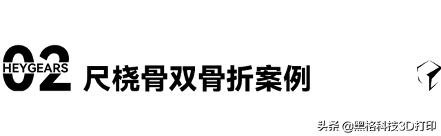 打了石膏痒怎么办