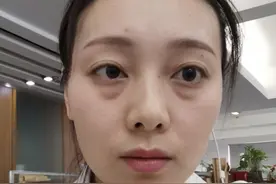年纪轻轻就被眼袋给整老了？教你几个小方法来缓解，简单效果好图片