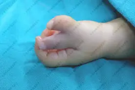 孩子先天性多指畸形，做手术的风险大吗？图片