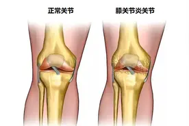 膝关节疼痛、肿胀，屈伸不利，一剂四神煎消肿祛痛专治膝，请体会图片