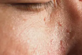 hpv病毒感染的皮肤表现居然是这样的，不看不知道图片