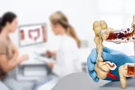 结肠息肉切除后怎么做？4个要点助你恢复图片