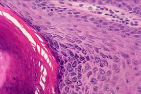 派特灵生物科普｜除HPV16/18，这两个高危HPV亚型也不能忽视图片