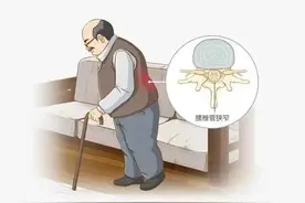 腰腿疼痛、麻木、跛行？腰椎管狭窄压迫坐骨神经导致的症状表现图片