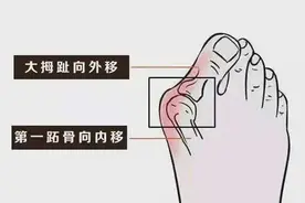 拇外翻？甲沟炎？足部困扰这样解决图片