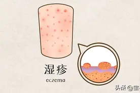 湿疹如果不治疗可以自愈吗？图片
