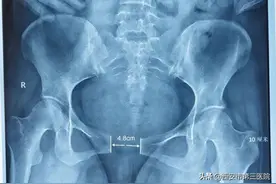 4.8cm！新晋宝妈直言自己“痛到怀疑人生”图片