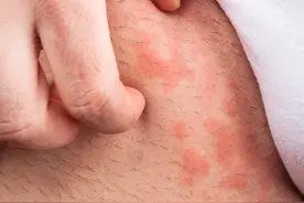 肚子周围起很多像蚊子叮的包很痒怎么回事越抓越痒越挠越大图片