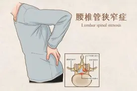 为什么腰椎管狭窄有人吃药就好，有人手术？这三类情况直接手术图片