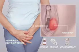 巴氏腺囊肿，女人难以启齿的痛，这种治疗方法可能会帮你免除手术图片