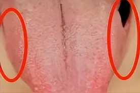 百病不离郁，肝郁从轻到重，4大阶段4种舌象，你属于哪一种图片