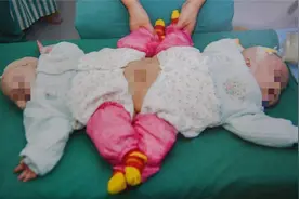2009年湖北女子生下一对“连体婴儿”，十年之后她们怎么样了图片