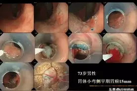 ​详解！内镜黏膜下剥离术（ESD）图片