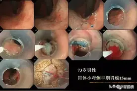 ​详解！内镜黏膜下剥离术（ESD）图片