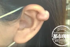 女子打完耳洞后，竟长了两个“肉球”！医生紧急提醒图片
