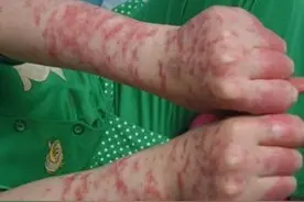 13岁女孩因系统性红斑狼疮想自杀，该病有哪些症状，哪些人容易得图片