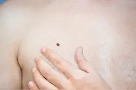 身体上3个部位的痣真的与癌症有关？如何判断？图片