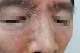 脸上又油又痒，医生说你可以这样做！图片