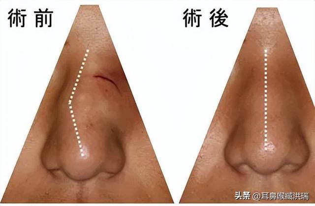 鼻中隔大讲堂：有鼻中隔偏曲25年了，北京手术费用一共多少钱？