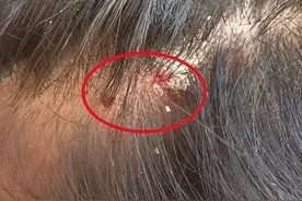 为何头皮上总是长疙瘩和脓包呢？是病吗？听听医生怎么说图片