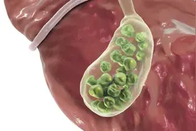 结石是“吃”出来的？医生：不想结石增长，5个饮食禁忌要注意图片