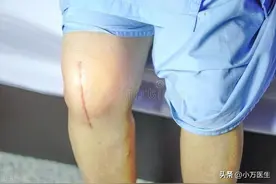 全膝关节置换术后康复计划，一篇搞定图片