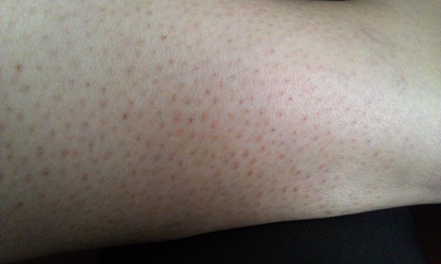 毛囊角化养生堂