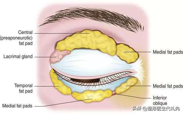 上眼睑眶隔脂肪释放填充眼窝凹陷,并不适合所有人