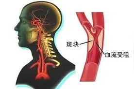 颈动脉有斑块，会有哪些症状？应该如何治疗？图片