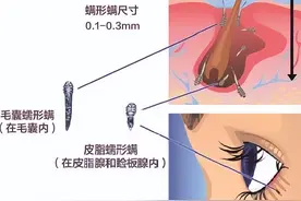 眼痒、眼干、眼红？小心眼睛“长虫子”了图片