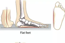 改善扁平足的一大神器，穿着就能矫正图片