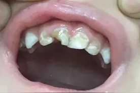 【预防】宝宝只喝奶也会坏牙齿？这样预防奶瓶龋才行图片