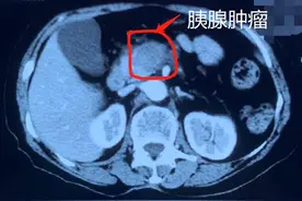发现胰腺占位，穿刺结果没有找到癌细胞，怎么办？图片