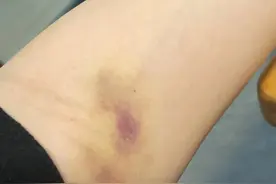 抽血后手臂为什么会淤青？图片