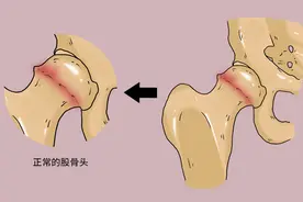 股骨头坏死被称为“不死的癌症”，怎么回事？为何难以治愈？图片